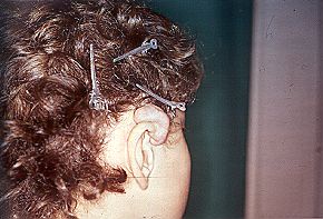 Figs. 11 - Keloid in upper third of auricle.