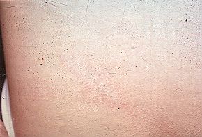 Fig. 14 - Inguinal donor site after one yr.