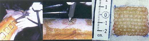 Fig. 1 - Experimental procedure to create bum wounds with silk touch C02 laser (left). Use of 2 mm round microprocessor scanner (centre). Close-up picture of bum wound (right).