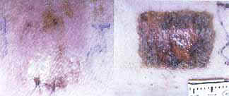 Fig. 4 - Planimetry. Scar formation after 7 days treated with MEBO (left). Control wound kept dry for the same period (right).