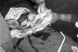 Fig. 1 - Extraction of foetus.