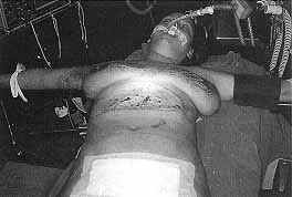 Fig. 2 - Patient after caesarian section.