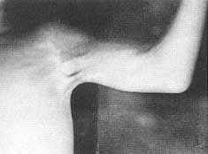 Fig. la - Retractile scar in armpit and anterior side of elbow. Liberation of armpit and repair with free skin graft. Two Z plasties were performed in the elbow.