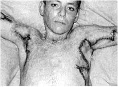 Fig. 2b - Post-operative result. armpits and elbow. Repair with skin flaps.