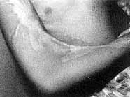 Fig. 3a - Retractile scar on anterior side of arm