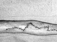 Fig. 3b - Repair with local flaps