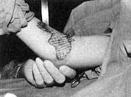 Fig. 4a - Retractile scar on anterior side of elbow. Wide removal, liberation of adjacent tissues, and repair with free skin graft.