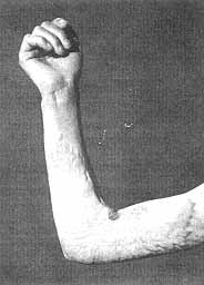 Fig. 5a - Retractile scar in the elbow.