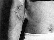Fig. 5b - Removal of scar. Tendons and vessels exposed. Correction with epigastric flap