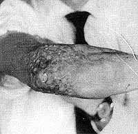 Fig. 6a - Retractile scar in elbow, with exposure of olecranon, preventing flexion. Repair with epigastric flap, offering good functional results.
