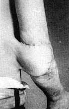 Fig. 6b - Retractile scar in elbow, with exposure of olecranon, preventing flexion. Repair with epigastric flap, offering good functional results.