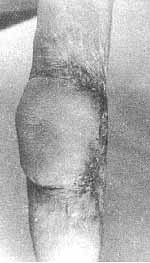 Fig. 6c - Retractile scar in elbow, with exposure of olecranon, preventing flexion. Repair with epigastric flap, offering good functional results.