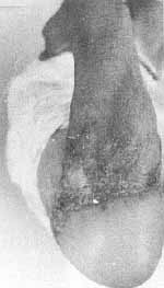 Fig. 6d - Retractile scar in elbow, with exposure of olecranon, preventing flexion. Repair with epigastric flap, offering good functional results.