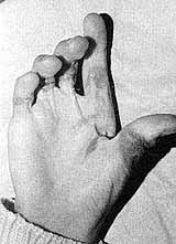 Fig. 7a - Claw-hand. Liberation of fingers and reconstruction of commissures with skingrafts