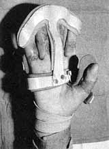 Fig. 7b - Hand ferule a] temating with active joint mobilization.