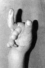 Fig. 8a - Large defect in hand.