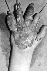 Fig. 8b - Removal of scar tissue and liberation of fingers and commissures.