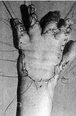 Fig. 8c - Repair with threequarters thickness free skin graft. The first three fingers were liberated and the fourth was later amputated, achieving a good holding function and mobility of the other fingers.