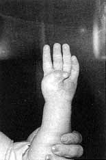 Fig. 9a - Thumb adhering to palm of hand with loss of first commissure. Total liberation of thumb and repair of palm and anterior surface of finger with groin flap.