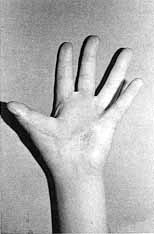 Fig. 9b - Thumb adhering to palm of hand with loss of first commissure. Total liberation of thumb and repair of palm and anterior surface of finger with groin flap.