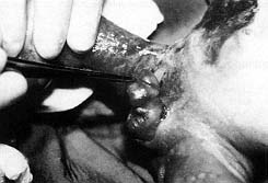 Fig. 1 - Baby with deep burns in flank, back, perineum, and both legs.