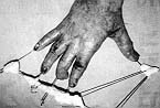 Fig. 1b - Dorsal view of right hand.