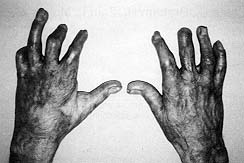 Fig. 2 - Hands of same patient one year later. The right third-finger distal phalanx could not be straightened and was later amputated. 