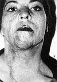 Fig. 2 - Résultats après excision cicatricielle et réparation par le lambeau expansé.