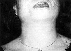 Fig. 4 - Résultat après réparation de l'étage inférieur de la face.