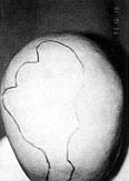 Fig. 5 - Alop�cie pari�to-frontaleale