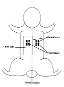 Fig. 1 - Schematic drawing of delay flap and bum rows applied in phase 2 of the study