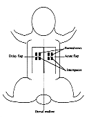 Fig. 2 - Schematic drawing of delay and acute flaps and bum rows in phase 3