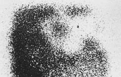 Fig.10 - Nuclear imaging of delay (d) versus acute (a) flaps. Note the distal and extensive decreased uptakes in the acute flap.