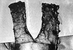 Fig. 12 - Appearance of undersurface of acute (a) and delay (d) flaps. Note the direction of vascular territories clearly seen in the acute flap. These territories could not be seen so easily under the delay flap because the silicone sheet placed under the delay flap caused thickening of the flap. 