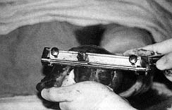 Fig. 1b - Excision tangentielle au dermatome