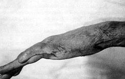 Fig. 4 - Bride latérodigital du Sème doigt