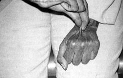 Fig. 4 - Bride latérodigital du Sème doigt