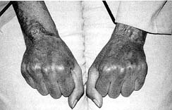 Fig. 5 - Résultat fonctionnel du 2ème cas avec borne texture cutanée 4ème mois post-brûlure; résultat