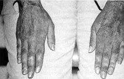Fig. 5 - Résultat fonctionnel du 2ème cas avec borne texture cutanée 4ème mois post-brûlure; résultat