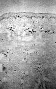 Fig. 3b - Partially recurring scar after surgical excision of K and silicone sheet application: lower numbers of CD4+ T-lymphocytes are present in the dermis compared with excised keloid (APAAP method, original magnification x 100)
