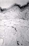 Fig. 4a - Keloid: a low number of CD36+ dermal dendrocytes is evident (APAAP method, original magnification x 100).