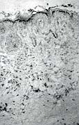 Fig. 4b - Partially recurring scar after surgical excision of K and silicone sheet application: higher numbers of CD36+ dermal dendrocytes are present in the dermis compared with excised keloid (APAAP method, original magnification x 100).