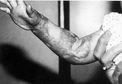 Fig. 1 - Infant with keloid scars before therapy.