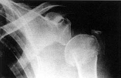 Fig. 1 - Appearance of fracture of left shoulder, including displacement and dislocation of three segments.
