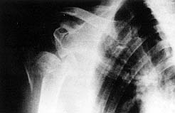 Fig. 2 - Dislocation and displacement of fractured segments of right shoulder. 