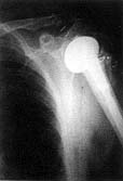 Fig. 3 - Shoulder arthroplastyperformed in left shoulder
