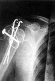 Fig. 4 - Fracture of right shoulder treated by internal reduction and fixation.