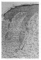 Fig. 10 - Microscopictissuemorphology of wound biopsy on day 13 from animal treated with TGF-l + bFGF. Similar appearance to control group.