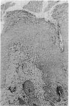 Fig. 11 - Microscopictissuemorphology of wound biopsy on day 13 from animal treated with IL-8. Compared with previous groups, a thick epithelial layer containing numerous rows of epithelial cells including skin appendages can be observed.