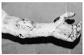 Fig. 7 - High-tension electrical injury of the forearm.